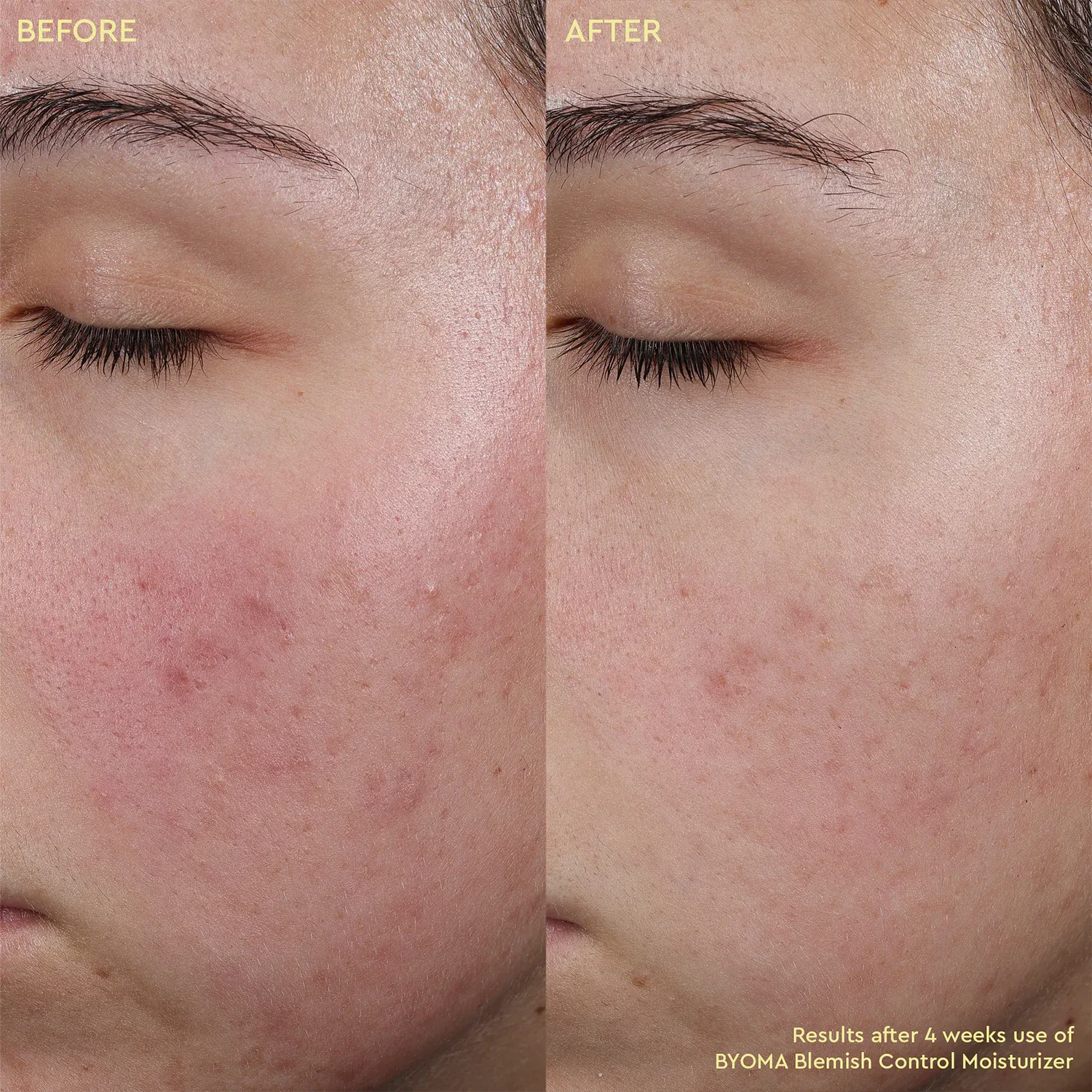 blemish control moisturizer - cilt kusurları karşıtı nemlendirici krem