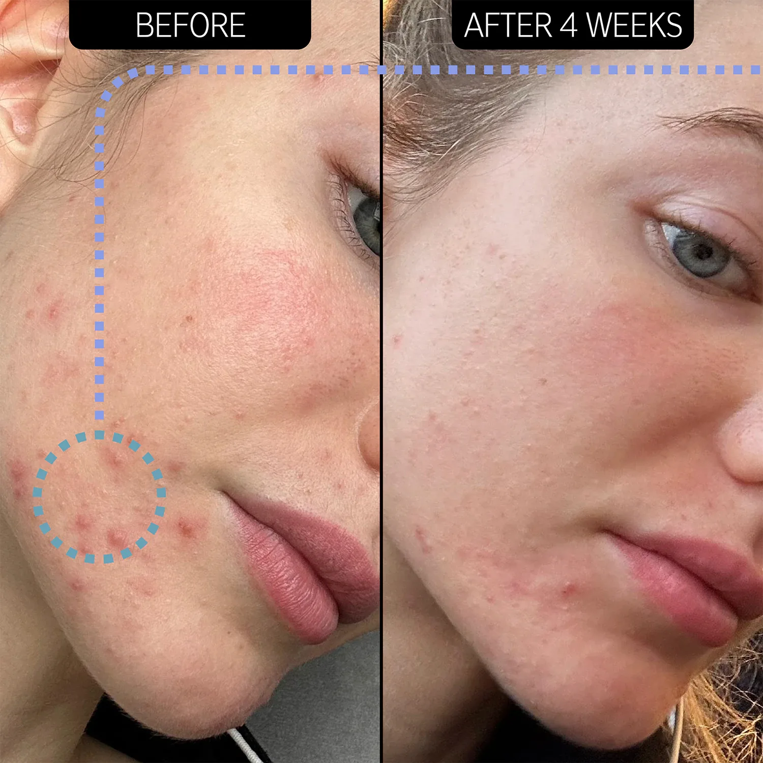 blemish clearing moisturizer 2% novoretin - nemlendirici gece kremi